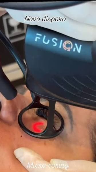 Aplicação do Fusion Cromatic (micro-coring)