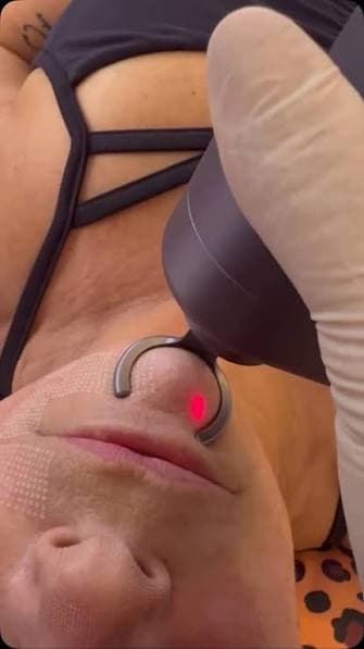 Protocolo Fusion Cromatic em região corporal